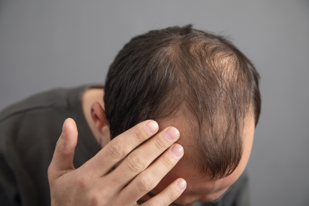 Hair Loss | Dr. Christopher Calapai